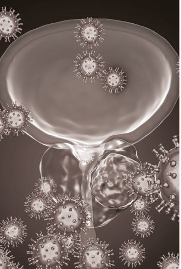 Ilustração de tumor de próstata — uro-oncologia no Rio de Janeiro, diagnóstico e tratamento do câncer de próstata na UroClínica Rio